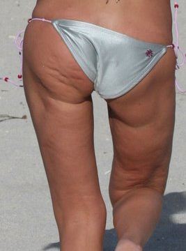 Até pessoas famosas, como a atriz americana Tara Reid sofrem com as celulites nas nádegas e na perna (Reprodução/Internet)