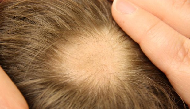 Segundo a dermatologista, a alopécia traz problemas apenas estéticos, e pode ser revertida, já que não mata os poros capilares (onlinedermclinic.com/Reprodução)