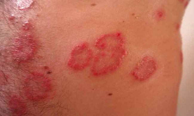 A psorase  uma doena hereditria e caracteriza-se pelas placas avermelhadas espessas espalhadas pela pele (Pixabay)