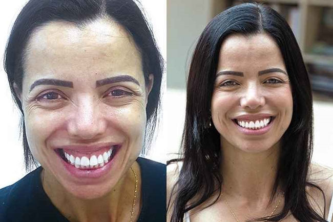 A fisioterapeuta Sheila Silene Soares antes e depois do tratamento para inibir a superexposio da gengiva: 'Antes eu evitava sorrir' (Rogrio Sol/Encontro/DA Press)