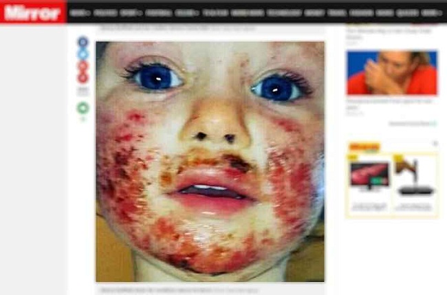Sienna Duffield, de 3 anos, passou por um tratamento de 8 meses após sofrer com os ferimentos causados pelo herpes, que pode ter sido transmitido por um adulto que a beijou no rosto (Mirror.co.uk/Reprodução)