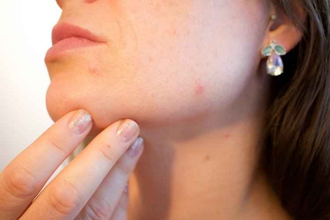 Segundo a especialista, mulheres com mais de 25 anos podem sofrer com a acne devido ao aumento da produo de hormnios masculinos (Pixabay)