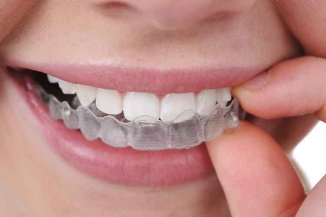 A novidade da odontologia é o uso de aparelho 'invisível' para correção de problemas nos dentes (Healthwaydentalgroup.com/Reprodução)