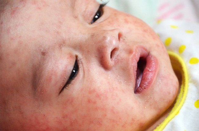 Crianas de um ano devem tomar a vacina trplice viral e, aos 15 meses, ganhar o reforo com a tetraviral. S assim o Brasil pode continuar livre do vrus do sarampo (Health.govt.nz/Reproduo)