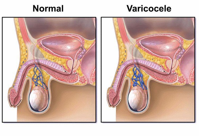 A varicolece ocorre quando vasos sanguneos de dentro do escroto acabam entupindo e formando 'varizes', que acabam levando  infertilidade masculina (Dovemed.com/Reproduo)